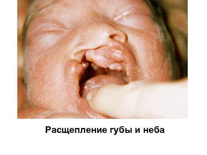 Расщепление губы и неба 