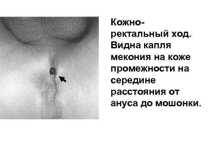 Кожноректальный ход. Видна капля мекония на коже промежности на середине расстояния от ануса до