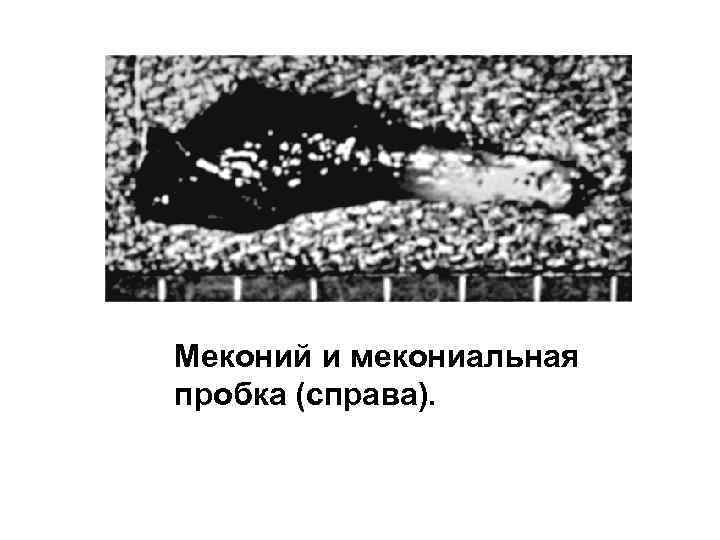 Меконий и мекониальная пробка (справа). 