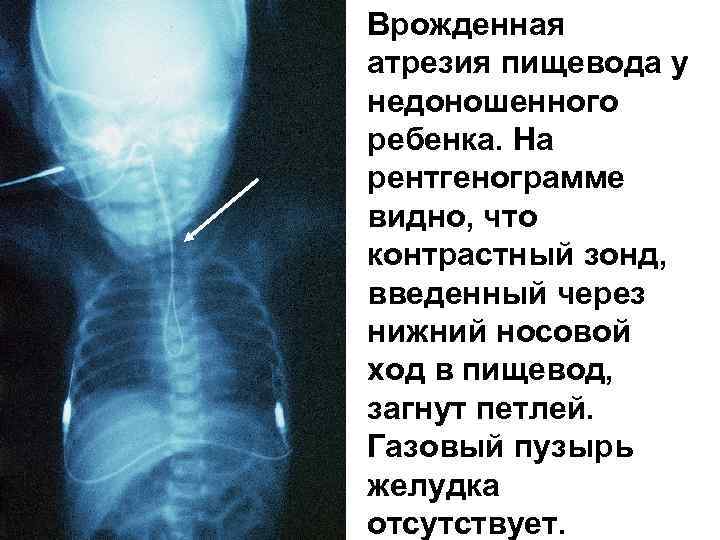 Врожденная атрезия пищевода у недоношенного ребенка. На рентгенограмме видно, что контрастный зонд, введенный через
