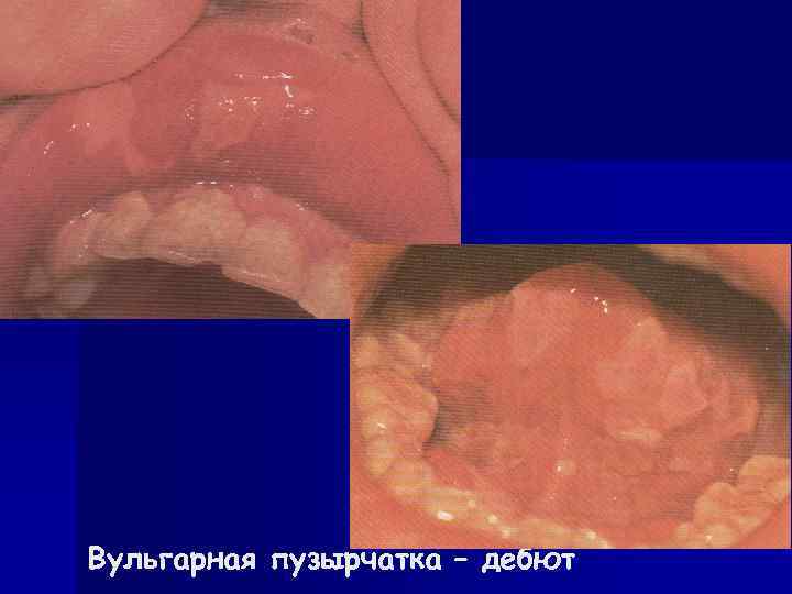 Вульгарная пузырчатка – дебют 