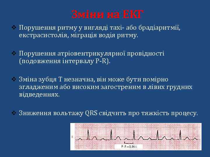 Зміни на ЕКГ v Порушення ритму у вигляді тахі- або брадіаритмії, екстрасистолія, міграція водія