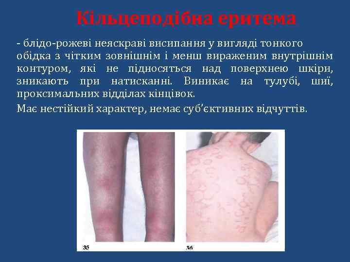 Кільцеподібна еритема - блідо-рожеві неяскраві висипання у вигляді тонкого обідка з чітким зовнішнім і