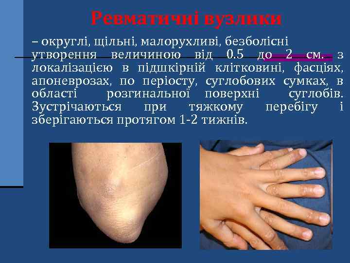 Ревматичні вузлики – округлі, щільні, малорухливі, безболісні утворення величиною від 0. 5 до 2