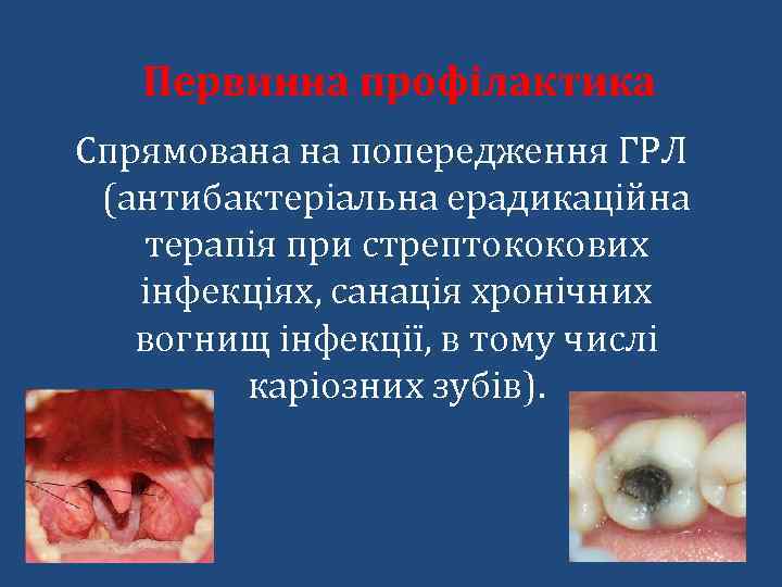 Первинна профілактика Спрямована на попередження ГРЛ (антибактеріальна ерадикаційна терапія при стрептококових інфекціях, санація хронічних