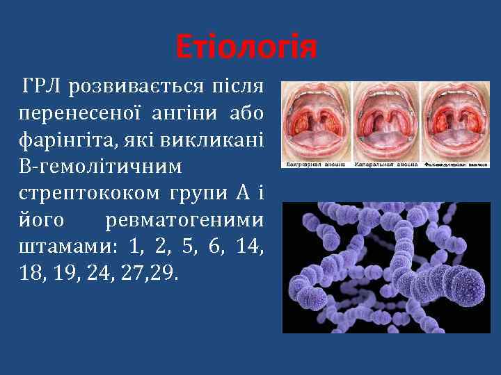 Етіологія ГРЛ розвивається після перенесеної ангіни або фарінгіта, які викликані В-гемолітичним стрептококом групи А