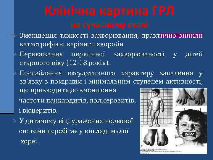 Клінічна картина ГРЛ на сучасному етапі Зменшення тяжкості захворювання, практично зникли катастрофічні варіанти хвороби.