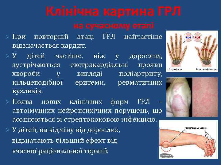 Клінічна картина ГРЛ на сучасному етапі При повторній атаці ГРЛ найчастіше відзначається кардит. Ø