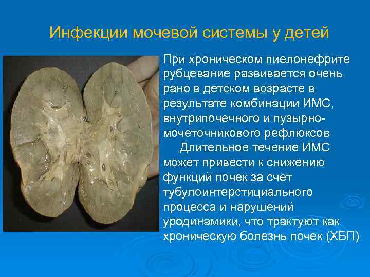 Инфекции мочевой системы у детей При хроническом пиелонефрите рубцевание развивается очень рано в детском