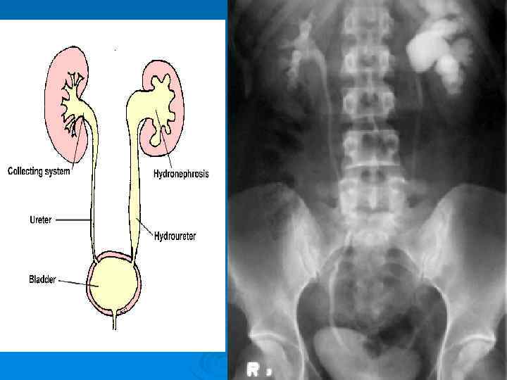 гидронефроз 