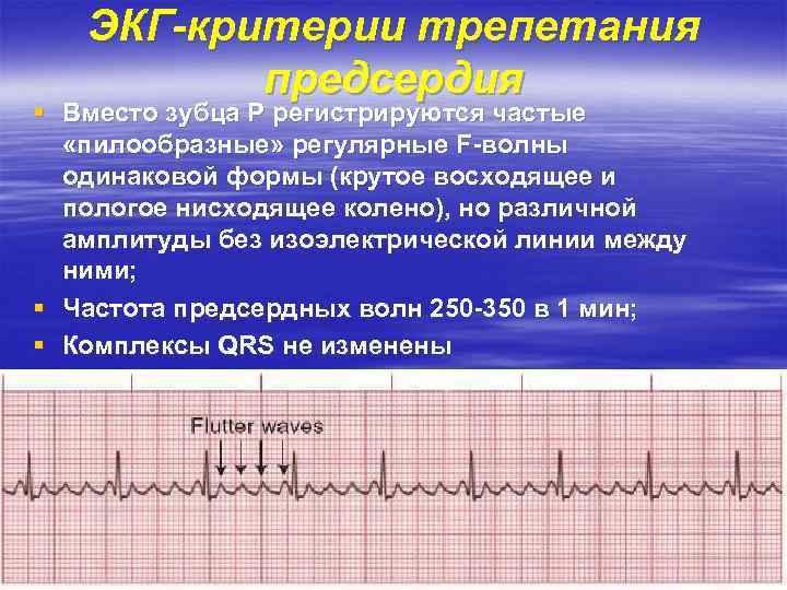 ЭКГ-критерии трепетания предсердия § Вместо зубца Р регистрируются частые «пилообразные» регулярные F-волны одинаковой формы