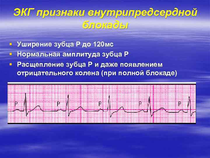 ЭКГ признаки внутрипредсердной блокады § Уширение зубца Р до 120 мс § Нормальная амплитуда