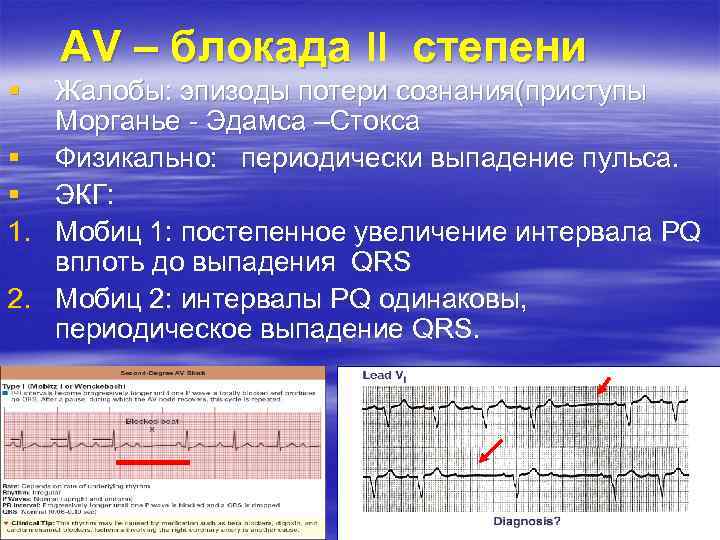 AV – блокада степени § Жалобы: эпизоды потери сознания(приступы Морганье - Эдамса –Стокса §