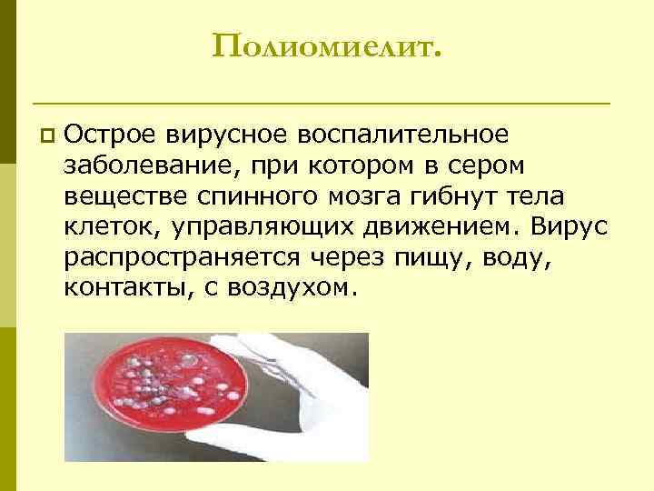 Полиомиелит. p Острое вирусное воспалительное заболевание, при котором в сером веществе спинного мозга гибнут