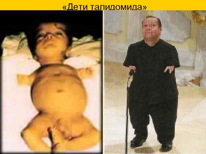  «Дети талидомида» 