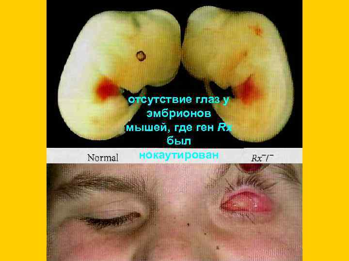 отсутствие глаз у эмбрионов мышей, где ген Rx был нокаутирован 
