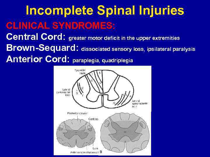 Incomplete Spinal Injuries CLINICAL SYNDROMES: Central Cord: greater motor deficit in the upper extremities