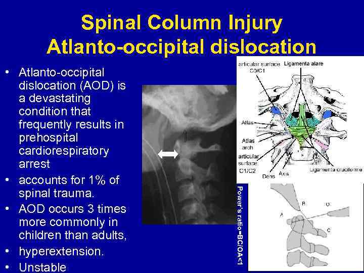 Spinal Column Injury Atlanto-occipital dislocation Power’s ratio=BC/OA<1 • Atlanto-occipital dislocation (AOD) is a devastating