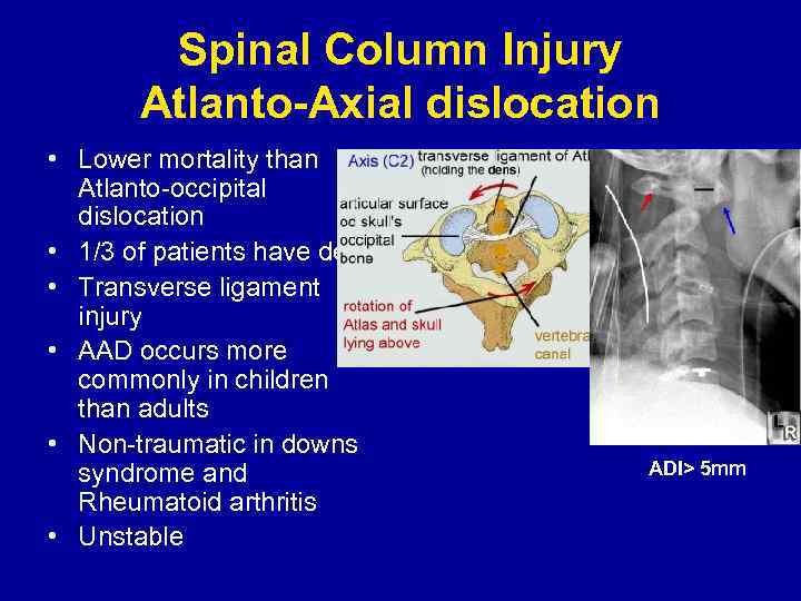 Spinal Column Injury Atlanto-Axial dislocation • Lower mortality than Atlanto-occipital dislocation • 1/3 of