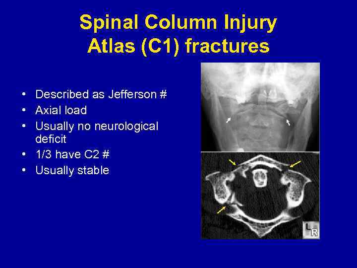 Spinal Column Injury Atlas (C 1) fractures • Described as Jefferson # • Axial