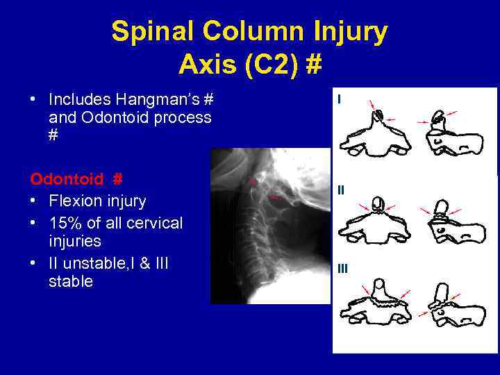 Spinal Column Injury Axis (C 2) # • Includes Hangman’s # and Odontoid process