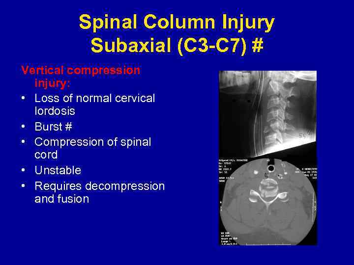 Spinal Column Injury Subaxial (C 3 -C 7) # Vertical compression injury: • Loss