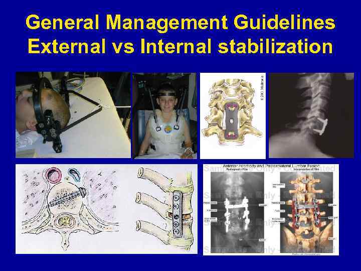 General Management Guidelines External vs Internal stabilization 