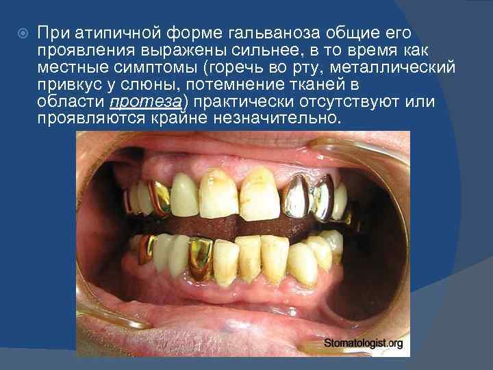  При атипичной форме гальваноза общие его проявления выражены сильнее, в то время как