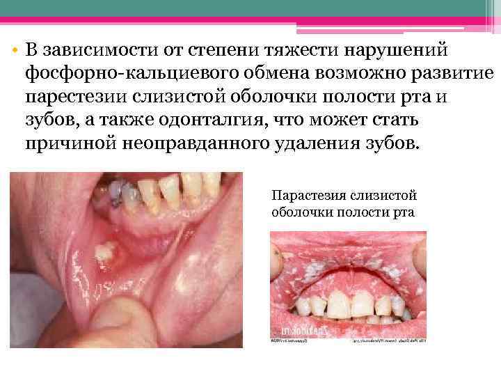  • В зависимости от степени тяжести нарушений фосфорно-кальциевого обмена возможно развитие парестезии слизистой