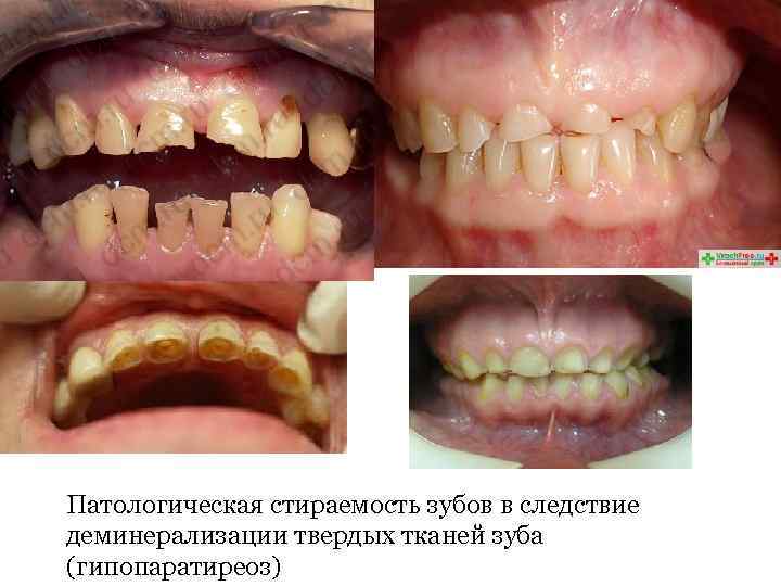 Патологическая стираемость зубов в следствие деминерализации твердых тканей зуба (гипопаратиреоз) 