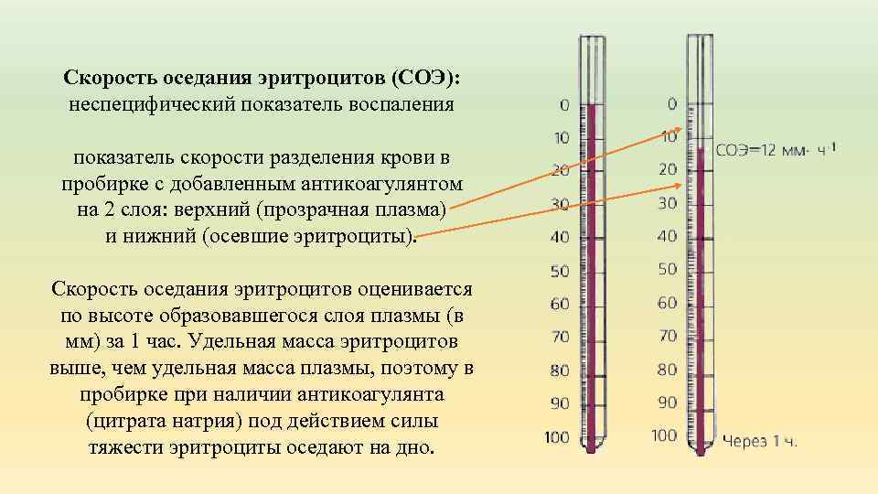 Скорость оседания эритроцитов (СОЭ): неспецифический показатель воспаления показатель скорости разделения крови в пробирке с