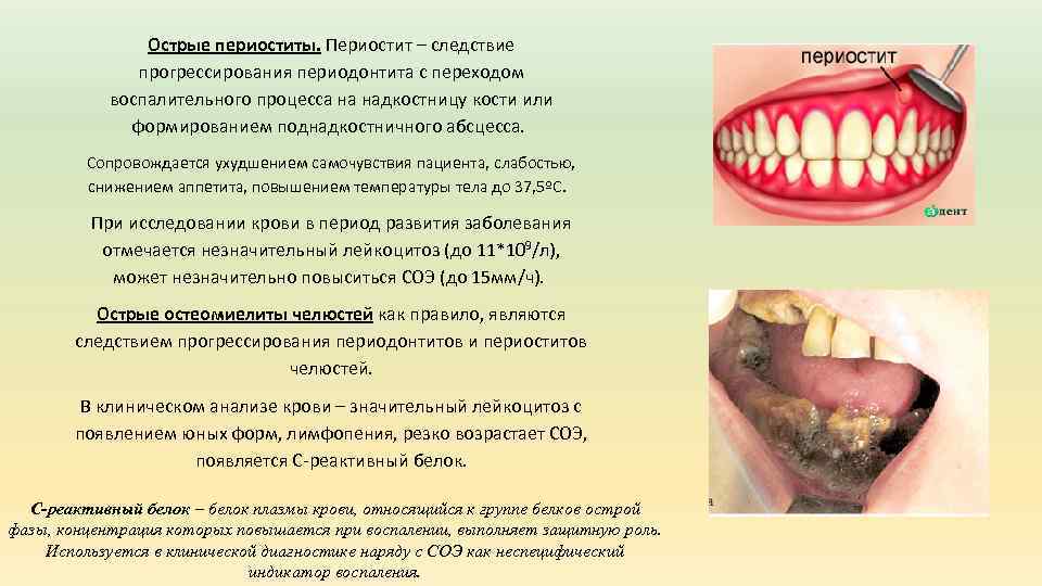 Острые периоститы. Периостит – следствие прогрессирования периодонтита с переходом воспалительного процесса на надкостницу кости