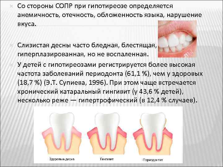  Со стороны СОПР при гипотиреозе определяется анемичность, отечность, обложенность языка, нарушение вкуса. Слизистая