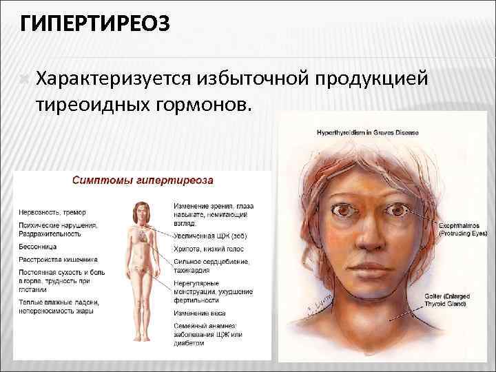 ГИПЕРТИРЕОЗ Характеризуется избыточной продукцией тиреоидных гормонов. 