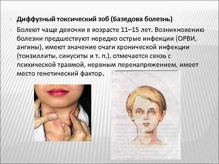  Диффузный токсический зоб (Базедова болезнь) Болеют чаще девочки в возрасте 11– 15 лет.