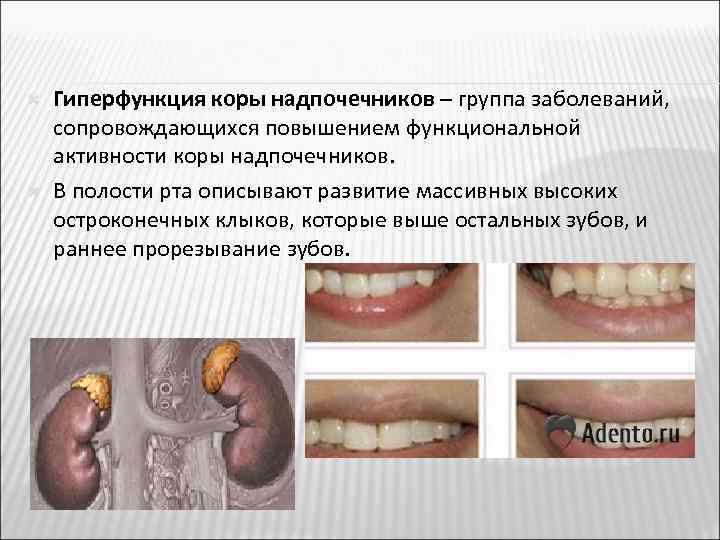  Гиперфункция коры надпочечников – группа заболеваний, сопровождающихся повышением функциональной активности коры надпочечников. В