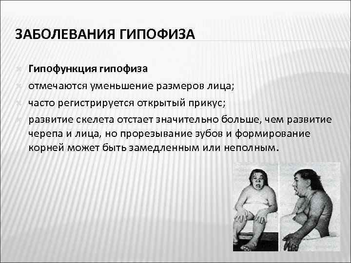  ЗАБОЛЕВАНИЯ ГИПОФИЗА Гипофункция гипофиза отмечаются уменьшение размеров лица; часто регистрируется открытый прикус; развитие