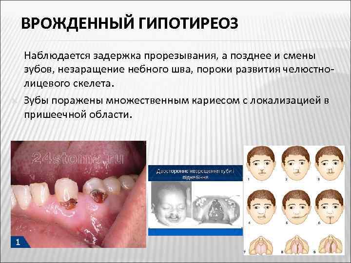 ВРОЖДЕННЫЙ ГИПОТИРЕОЗ Наблюдается задержка прорезывания, а позднее и смены зубов, незаращение небного шва, пороки