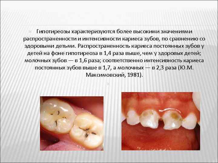 Гипотиреозы характеризуются более высокими значениями распространенности и интенсивности кариеса зубов, по сравнению со здоровыми