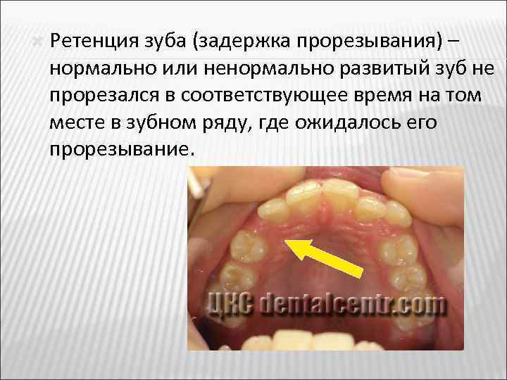 Прорезывание зубов фото поэтапно