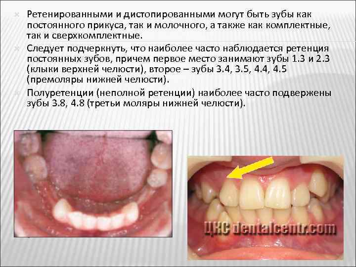  Ретенированными и дистопированными могут быть зубы как постоянного прикуса, так и молочного, а