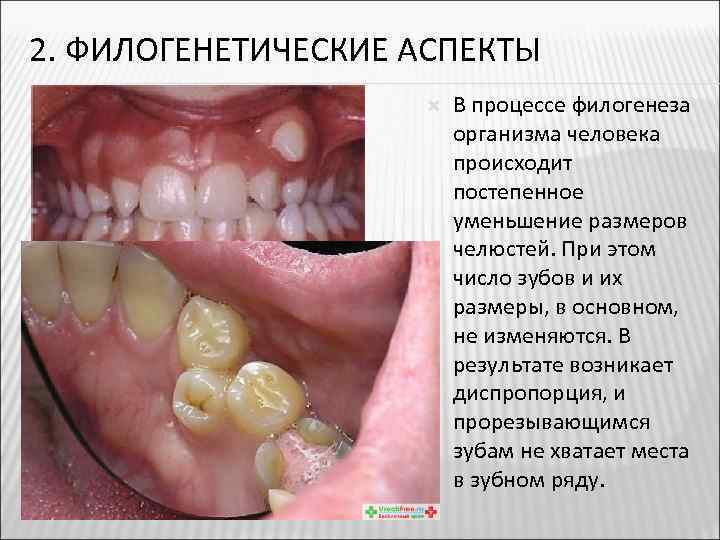 Прорезывание зубов фото поэтапно