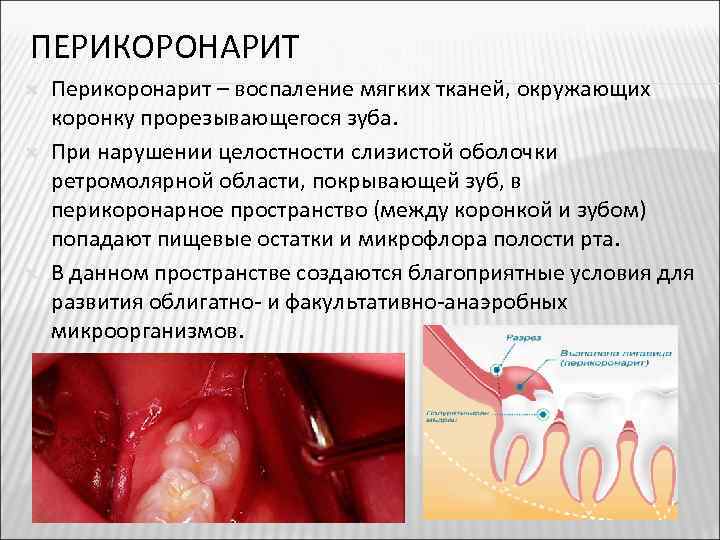 ПЕРИКОРОНАРИТ Перикоронарит – воспаление мягких тканей, окружающих коронку прорезывающегося зуба. При нарушении целостности слизистой