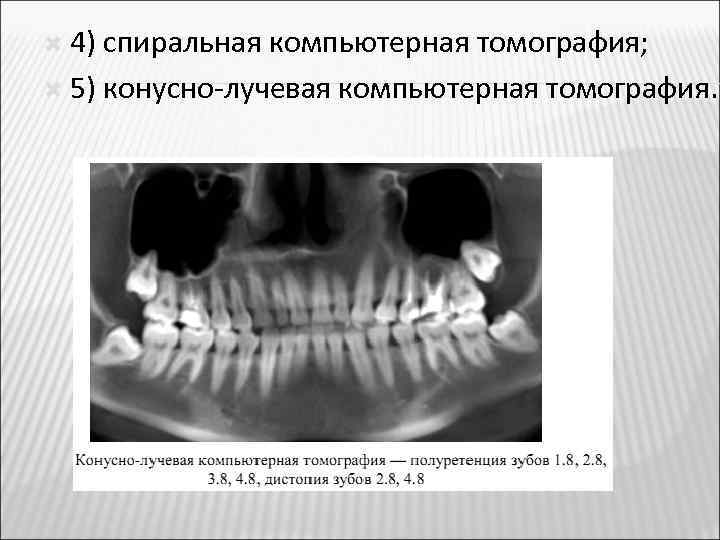  4) спиральная компьютерная томография; 5) конусно-лучевая компьютерная томография. 