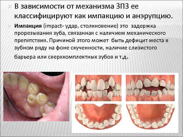  В зависимости от механизма ЗПЗ ее классифицируют как импакцию и анэрупцию. Импакция (impact-