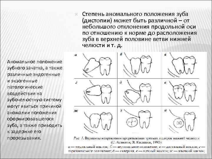  Аномальное положение зубного зачатка, а также различные эндогенные и экзогенные патологические воздействия на
