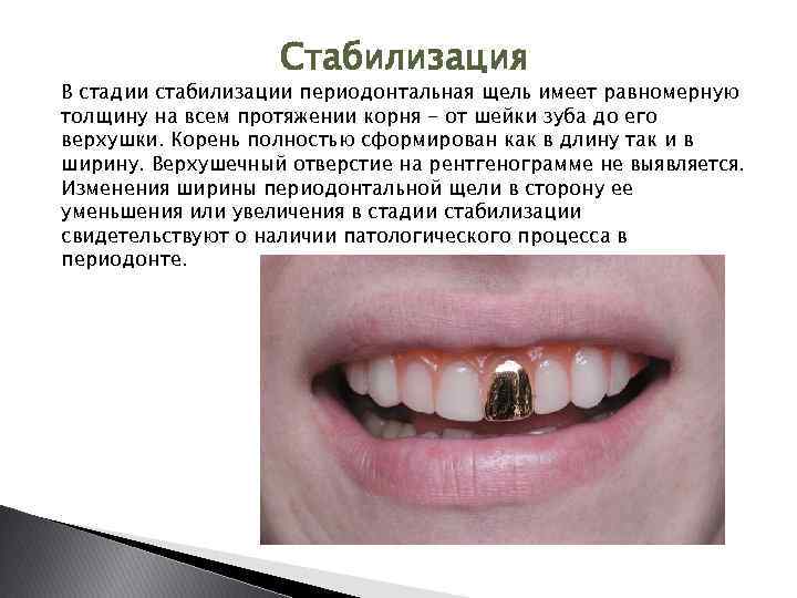 Стабилизация В стадии стабилизации периодонтальная щель имеет равномерную толщину на всем протяжении корня -