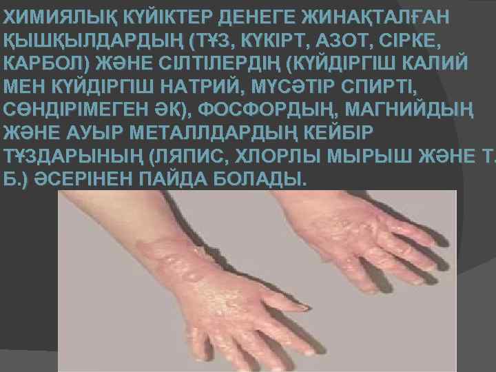 ХИМИЯЛЫҚ КҮЙІКТЕР ДЕНЕГЕ ЖИНАҚТАЛҒАН ҚЫШҚЫЛДАРДЫҢ (ТҰЗ, КҮКІРТ, АЗОТ, СІРКЕ, КАРБОЛ) ЖӘНЕ СІЛТІЛЕРДІҢ (КҮЙДІРГІШ КАЛИЙ