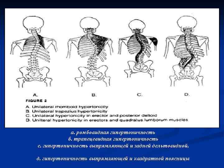 а. ромбовидная гипертоничность б. трапецевидная гипертоничность с. гипертоничность выпрямляющей и задней дельтовидной. д. гипертоничность