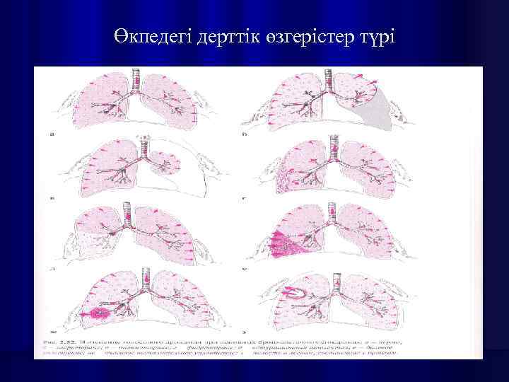 Өкпедегі дерттік өзгерістер түрі 